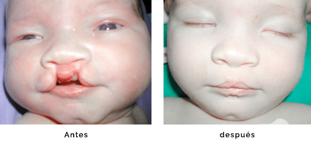Operación de una fisura palatina, foto antes y después  | Fisuras Labiopalatinas