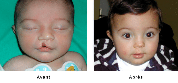 Enfant porteur d’une fente labiale droite isolée , opéré à l’âge de un mois , aspect de la lèvre à un an