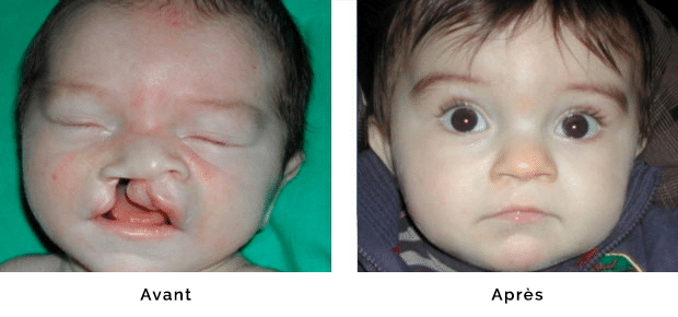 Enfant porteur d’une fente labio palatine droite totale large , réparation de la lèvre et du nez dans le même temps opératoire à l’âge de un mois, fermeture du palais à l’âge de six mois, aspect de la lèvre et du nez à l’âge de un an
