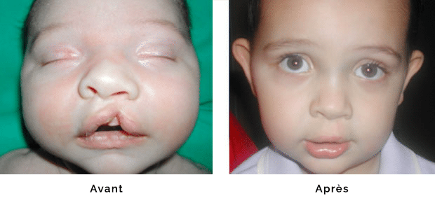 Enfant porteur d’une fente labiale gauche isolée , opéré à l’âge de un mois , aspect de la lèvre à trois ans