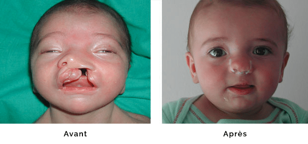 Enfant porteur d’une fente labio palatine gauche totale large , réparation de la lèvre et du nez dans le même temps opératoire à l’âge de un mois, fermeture du palais à l’âge de six mois, aspect de la lèvre et du nez à l’âge de 8 mois, stabilité du résultat sue le nez grace à un conformateur narinaire ( en place )