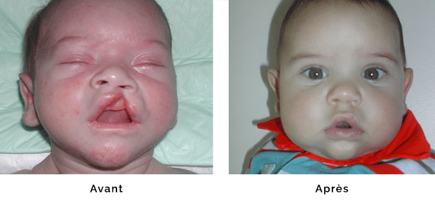 Enfant porteur d’une fente labiale gauche complète mais isolée , opéré à l’âge de un mois , aspect de la lèvre à six mois