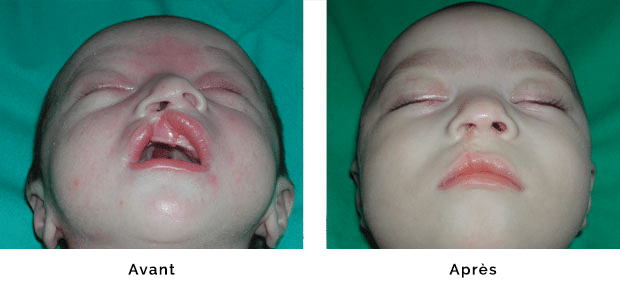 Enfant porteur d’une fente labio palatine droite isolée, réparation de la lèvre et du nez dans le même temps opératoire à l’âge de un mois , aspect de la lèvre et du nez en vue sous nasale à l’âge de 6 mois, le jour de la chirurgie de fermeture de la fente palatine.