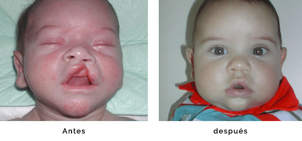 Cirugía de fisura labial, antes y después | Fisuras Labiopalatinas