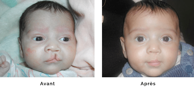 Enfant porteur d’une fente labiale gauche isolée verticale, opéré à l’âge de un mois , aspect de la lèvre à un an