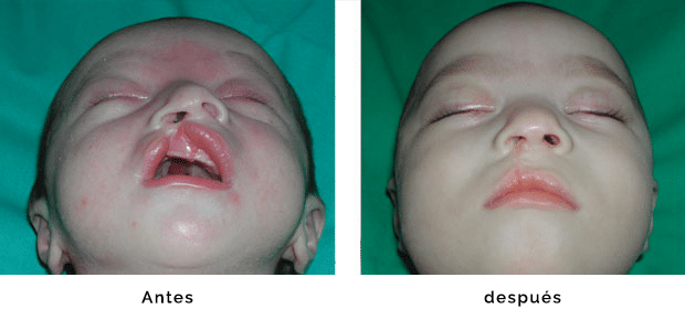 Cirugía de fisura labiopalatina - antes y después | Fisuras Labiopalatinas