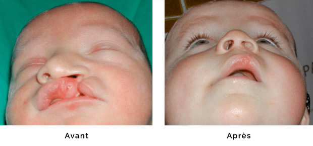 Enfant porteur d’une fente labio maxillaire gauche isolée sans fente palatine, réparation de la lèvre et du nez dans le même temps opératoire à l’âge de un mois , aspect de la lèvre et du nez en vue sous nasale à l’âge de 6 mois