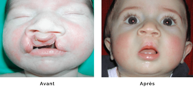 Enfant porteur d’une fente labio maxillaire bilatérale isolée sans fente palatine, réparation de la lèvre et du nez dans le même temps opératoire à l’âge de un mois , aspect après réparation de la lèvre et du nez vers l’âge de un an