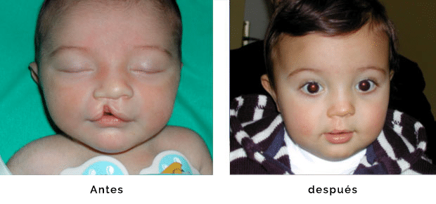 Fisuras labiales antes y después de una cirugía | Fisuras Labiopalatinas