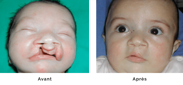 Enfant porteur d’une fente labio maxillaire bilatérale avec fente palatine, réparation de la lèvre et du nez dans le même temps opératoire à l’âge de un mois , réparation du palais à l’âge de six mois, aspect après réparation de la lèvre et du nez vers l’âge de un an