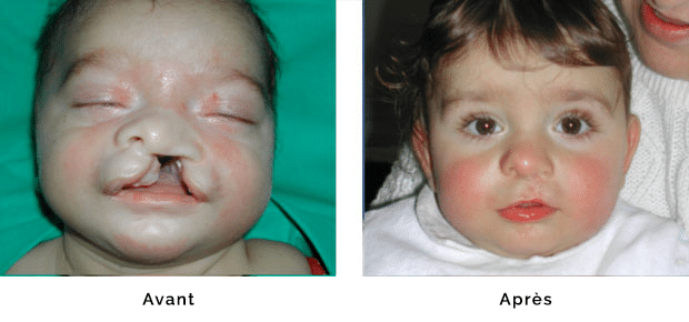 Enfant porteur d’une fente labio palatine gauche totale large , réparation de la lèvre et du nez dans le même temps opératoire à l’âge de un mois, fermeture du palais à l’âge de six mois, aspect de la lèvre et du nez à l’âge de un an