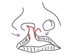 Opération de la lèvre | Fentes Labio Palatines