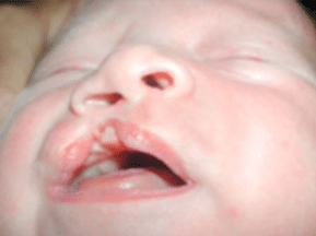 Bébé porteur d'une fente labiale droite | Fentes Labio Palatines