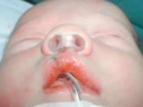 Fente labiale droite d'un bébé | Fentes Labio Palatines