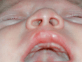 Bébé porteur d'une fente labiale à droite | Fentes Labio Palatines