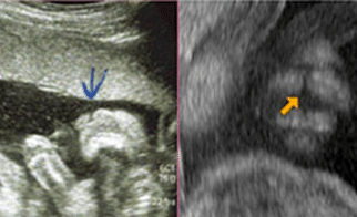 Echographie et diagnostic d'une Fente Palatine | Fentes Labio Palatines