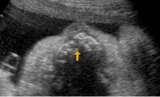 Echographie et détection d'un Bec de Lièvre | Fentes Labio Palatines