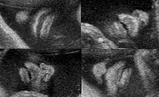 Echographie normale des fentes labiopalatines| Fentes Labio Palatines