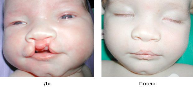 Операция расщелины нёба, Фото до и после | Расщепление губы и нёба