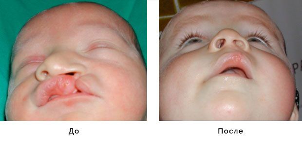 Расщелина губы : Результат до и после хирургии| Расщепление губы и нёба