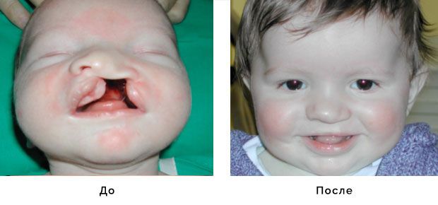 Результат до и после хирургии расщепления нёба | Расщепление губы и нёба