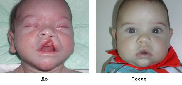 Хирургия расщелины нёба, до и после хирургии | Расщепление губы и нёба