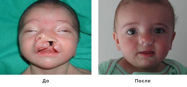 Хирургия расщелины губы и нёба  до и после  | Расщепление губы и нёба