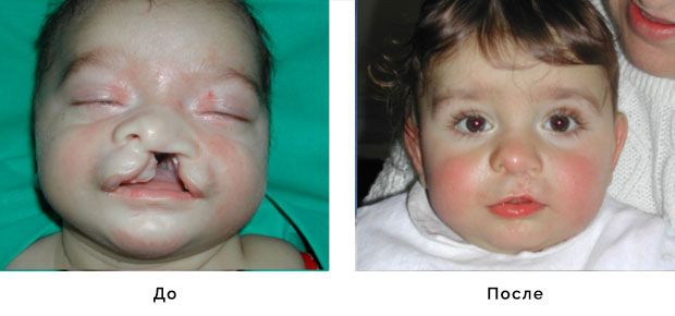 Расщелина нёба : Результат до и после хирургии|  | Расщепление губы и нёба