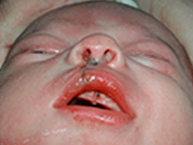 Корреция губы и положения носа | Расщепление губы и нёба