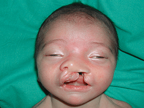 Одностороннее расщепление губы и нёба младенца |Расщепление губы и нёба