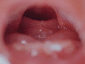 Синдром Пьера Робена : Округлая расщелина нёба | Расщепление губы и нёба