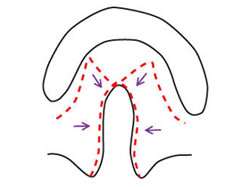 Diagrama d'una fissura palatina abans del tancament | Fissures Palatines i Llavi Leporí