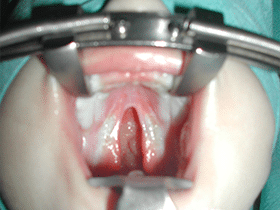 Operació de paladar i fissura palatina abans del tancament | Fissures Palatines i Llavi Leporí