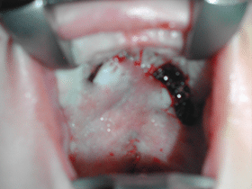 Fissura palatina: resultat a la fi de la cirurgia | Fissures Palatines i Llavi Leporí