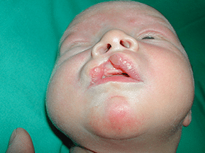 Fissura labial sense deformació | Fissures Palatines i Llavi Leporí