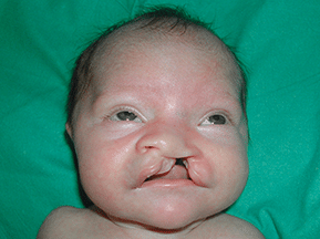 Cirugía de fisura palatina para bebés | Fisuras Labiopalatinas