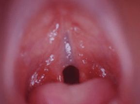 Fisura palatina bajo la mucosa del velo | Fisuras Labiopalatinas